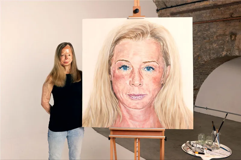 Acid Survivors Trust International (ASTi) "End Acid Violence"
