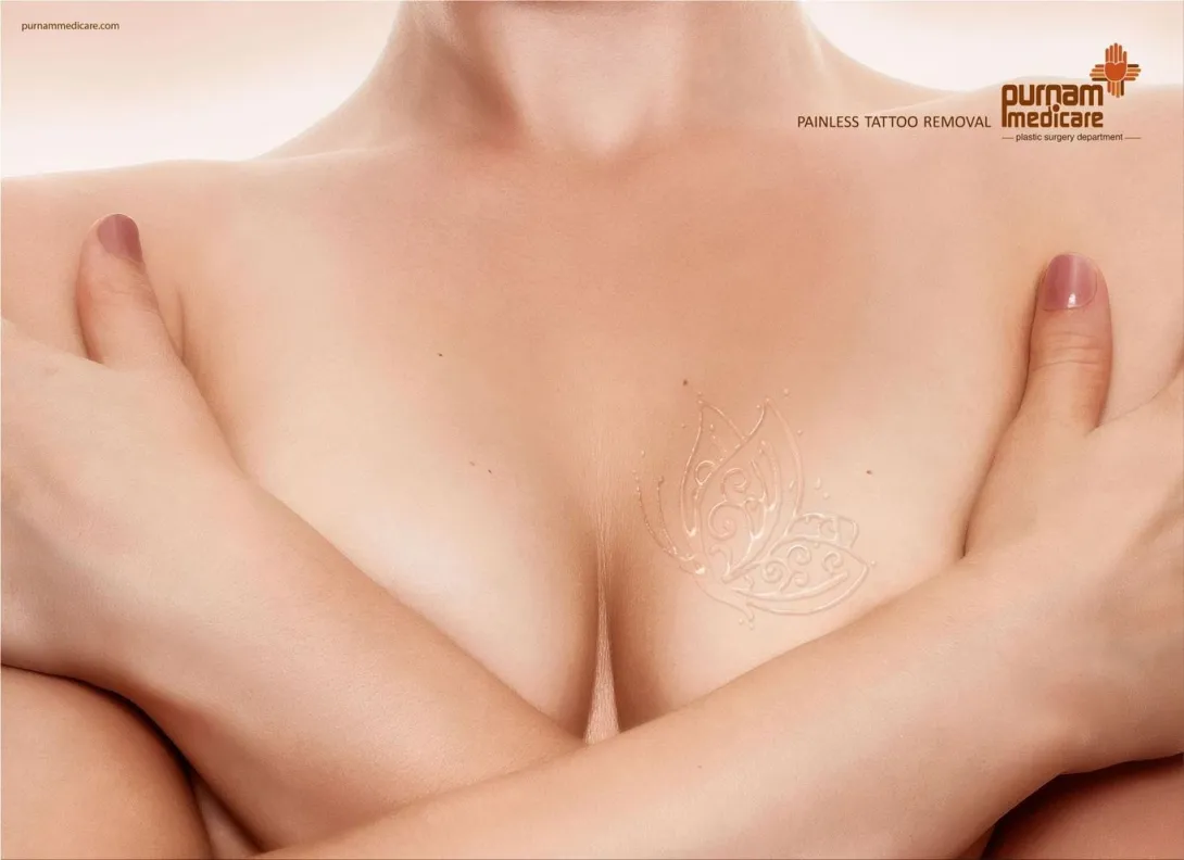 Purnam Medicare: "Painless tattoo removal."