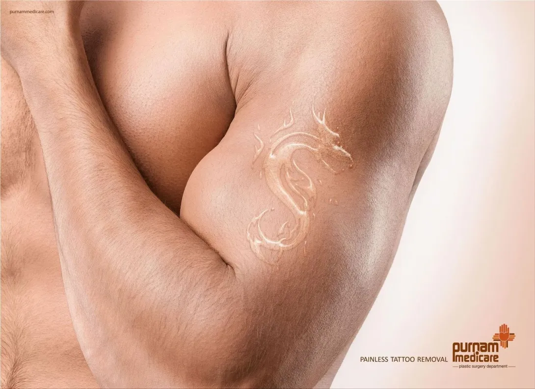 Purnam Medicare: "Painless tattoo removal."